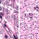 Optical histologic images showing two different forms of brain tumors, diffuse astrocytoma (left) and meningioma (right).